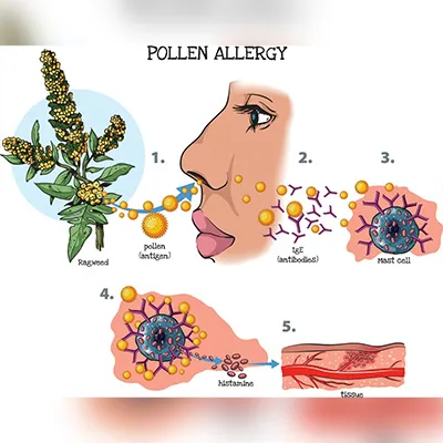 Process of airborne allergy reaction in the human body